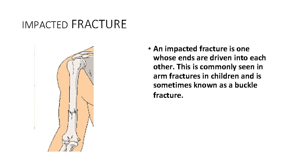 IMPACTED FRACTURE • An impacted fracture is one whose ends are driven into each