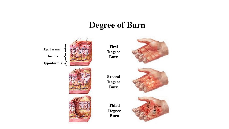 Degree of Burn Epidermis Dermis First Degree Burn Hypodermis Second Degree Burn Third Degree