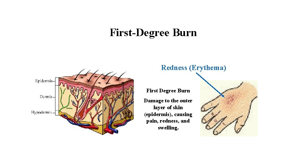 First-Degree Burn Redness (Erythema) First Degree Burn Epidermis Dermis Hypodermis Damage to the outer