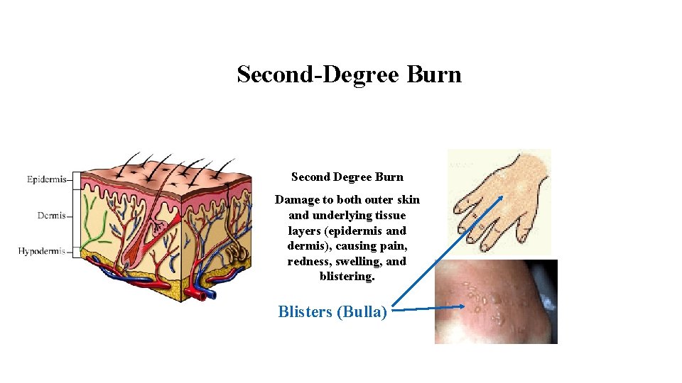 Second-Degree Burn Second Degree Burn Damage to both outer skin and underlying tissue layers