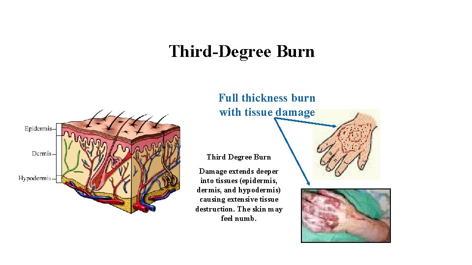 Third-Degree Burn Full thickness burn with tissue damage Third Degree Burn Damage extends deeper