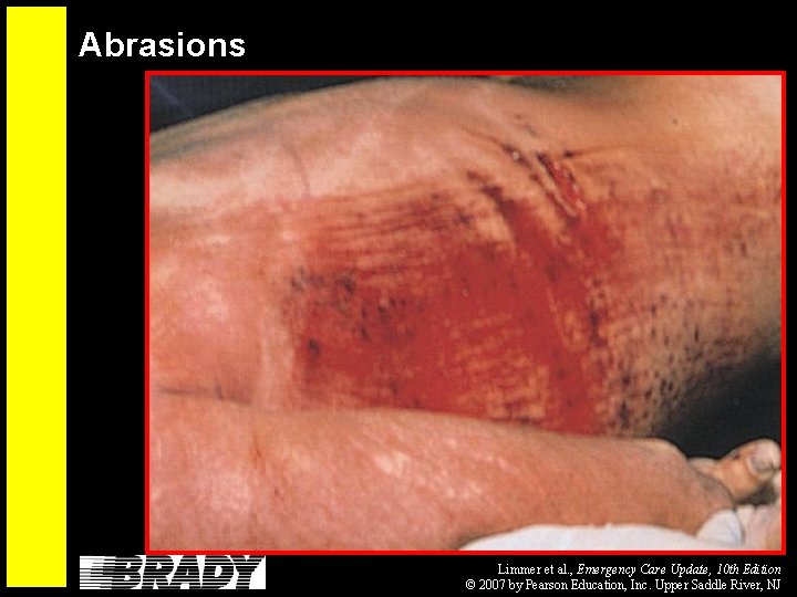 Abrasions Limmer et al. , Emergency Care Update, 10 th Edition © 2007 by