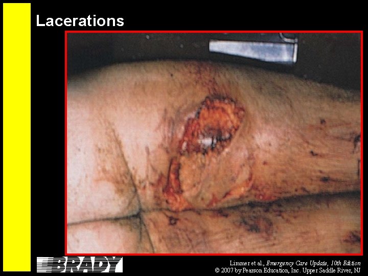 Lacerations Limmer et al. , Emergency Care Update, 10 th Edition © 2007 by