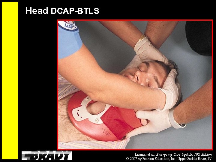 Head DCAP-BTLS Limmer et al. , Emergency Care Update, 10 th Edition © 2007
