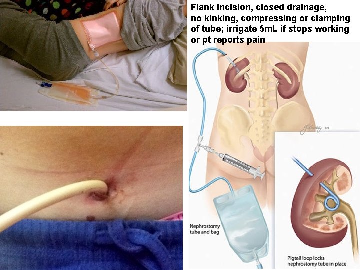 Flank incision, closed drainage, no kinking, compressing or clamping of tube; irrigate 5 m.