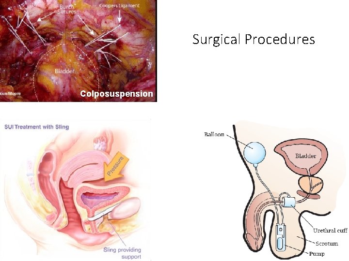 Surgical Procedures Colposuspension 