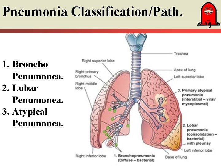 Pneumonia Classification/Path. 1. Broncho Penumonea. 2. Lobar Penumonea. 3. Atypical Penumonea. 