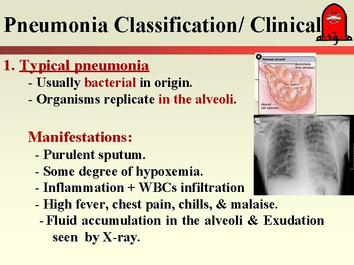 Pneumonia Classification/ Clinical 1. Typical pneumonia - Usually bacterial in origin. - Organisms replicate