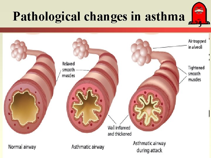 Pathological changes in asthma 