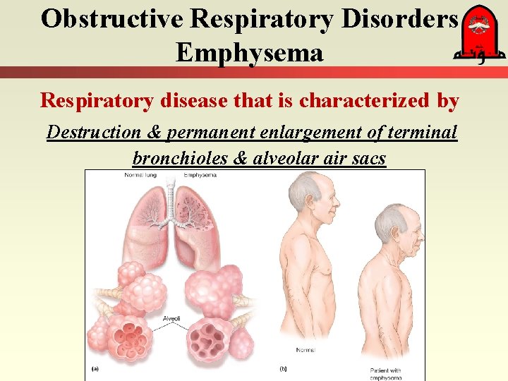 Obstructive Respiratory Disorders Emphysema Respiratory disease that is characterized by Destruction & permanent enlargement