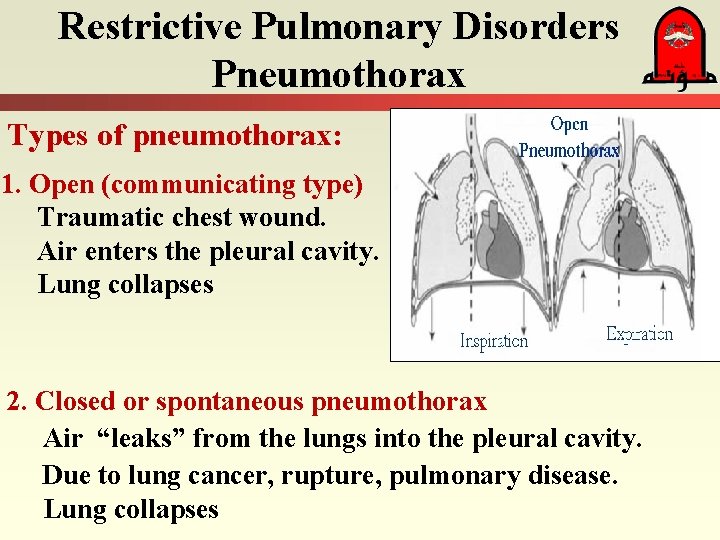 Restrictive Pulmonary Disorders Pneumothorax Types of pneumothorax: 1. Open (communicating type) Traumatic chest wound.