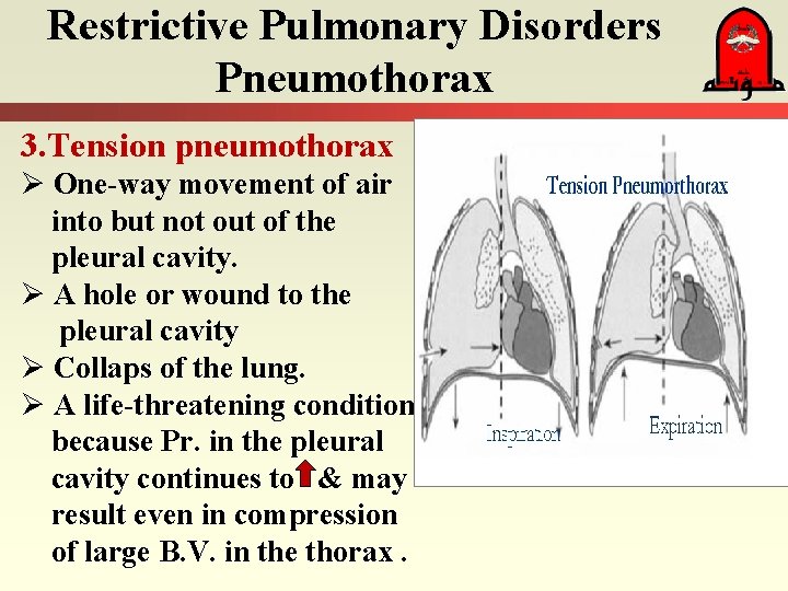 Restrictive Pulmonary Disorders Pneumothorax 3. Tension pneumothorax Ø One-way movement of air into but