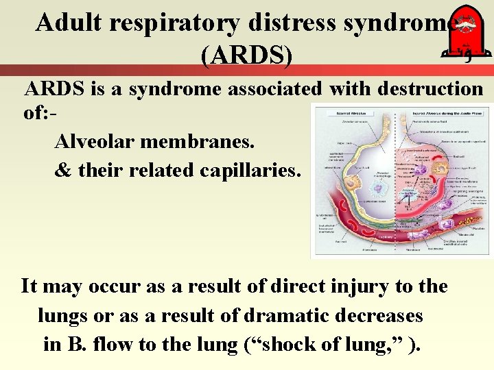 Adult respiratory distress syndrome (ARDS) ARDS is a syndrome associated with destruction of: Alveolar