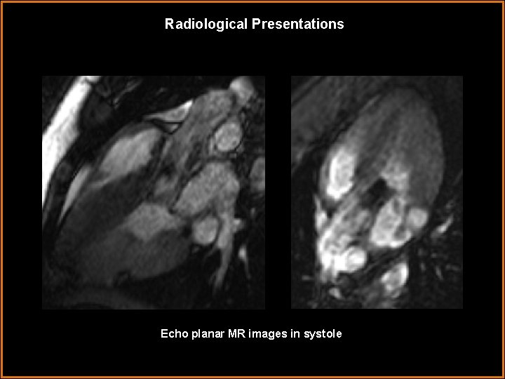 Radiological Presentations Echo planar MR images in systole 