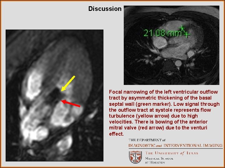 Discussion Focal narrowing of the left ventricular outflow tract by asymmetric thickening of the