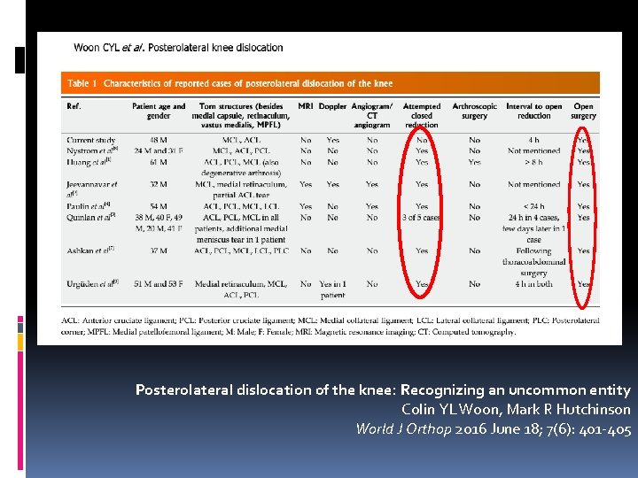 Posterolateral dislocation of the knee: Recognizing an uncommon entity Colin YL Woon, Mark R
