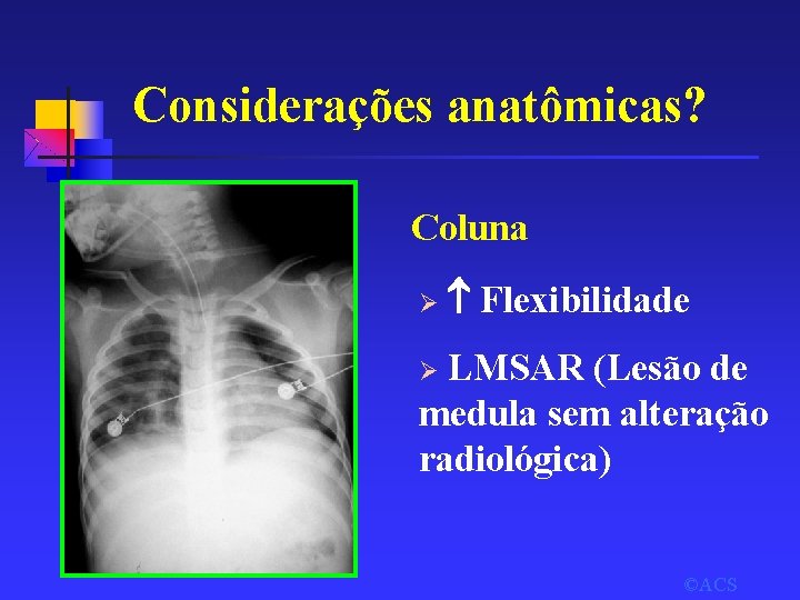 Considerações anatômicas? Coluna Ø Flexibilidade LMSAR (Lesão de medula sem alteração radiológica) Ø ©ACS