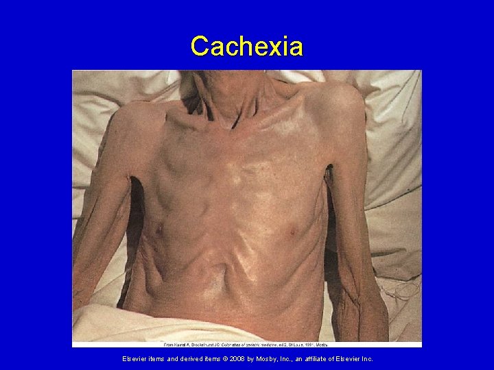 Cachexia Elsevier items and derived items © 2008 by Mosby, Inc. , an affiliate