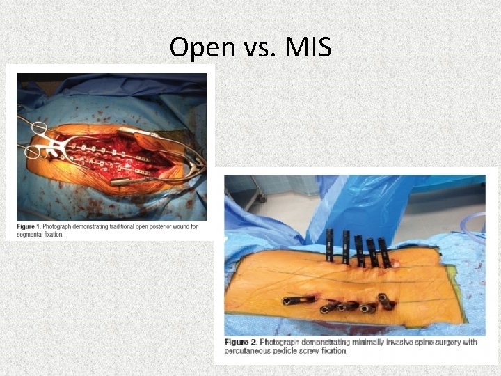 Open vs. MIS 