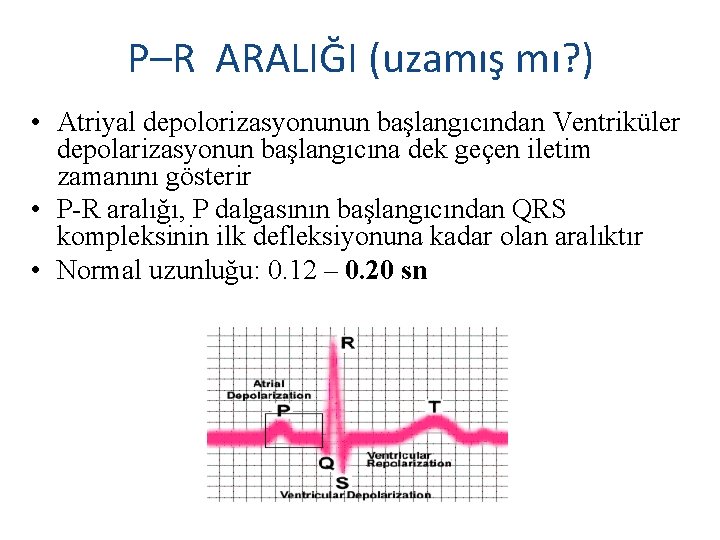 P–R ARALIĞI (uzamış mı? ) • Atriyal depolorizasyonunun başlangıcından Ventriküler depolarizasyonun başlangıcına dek geçen