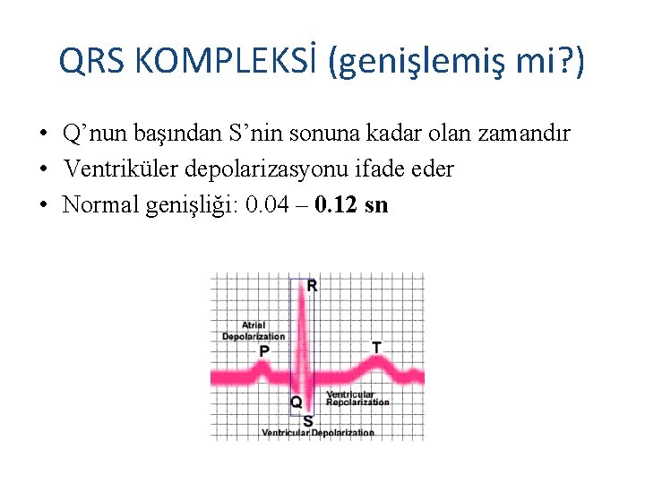 QRS KOMPLEKSİ (genişlemiş mi? ) • Q’nun başından S’nin sonuna kadar olan zamandır •