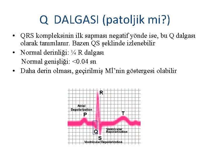 Q DALGASI (patoljik mi? ) • QRS kompleksinin ilk sapması negatif yönde ise, bu