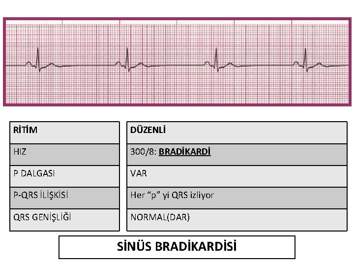 RİTİM DÜZENLİ HIZ 300/8: BRADİKARDİ P DALGASI VAR P-QRS İLİŞKİSİ Her “p” yi QRS