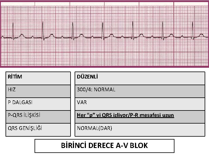 RİTİM DÜZENLİ HIZ 300/4: NORMAL P DALGASI VAR P-QRS İLİŞKİSİ Her “p” yi QRS