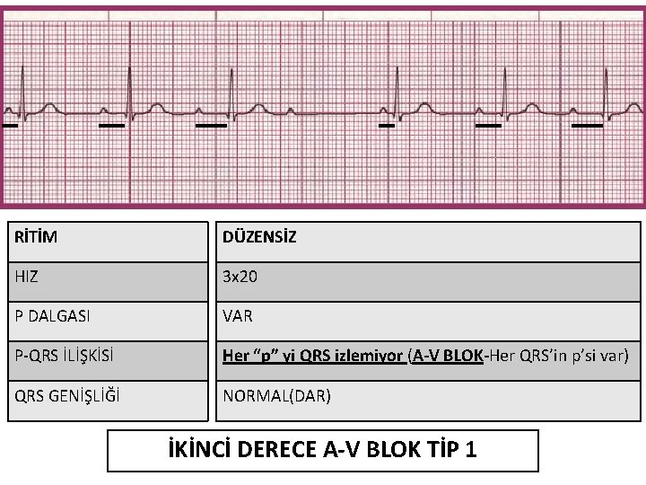 RİTİM DÜZENSİZ HIZ 3 x 20 P DALGASI VAR P-QRS İLİŞKİSİ Her “p” yi