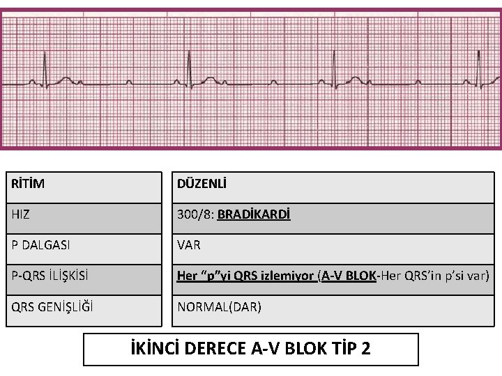 RİTİM DÜZENLİ HIZ 300/8: BRADİKARDİ P DALGASI VAR P-QRS İLİŞKİSİ Her “p”yi QRS izlemiyor