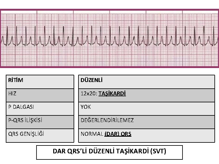 RİTİM DÜZENLİ HIZ 12 x 20: TAŞİKARDİ P DALGASI YOK P-QRS İLİŞKİSİ DEĞERLENDİRİLEMEZ QRS