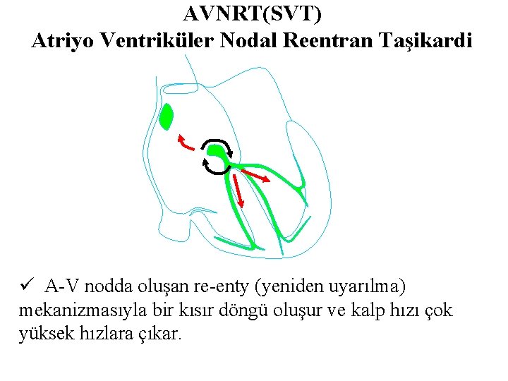 AVNRT(SVT) Atriyo Ventriküler Nodal Reentran Taşikardi ü A-V nodda oluşan re-enty (yeniden uyarılma) mekanizmasıyla