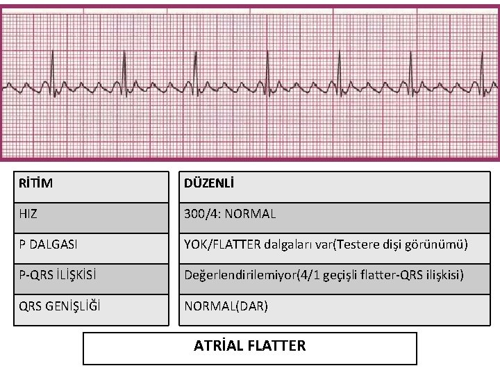 RİTİM DÜZENLİ HIZ 300/4: NORMAL P DALGASI YOK/FLATTER dalgaları var(Testere dişi görünümü) P-QRS İLİŞKİSİ