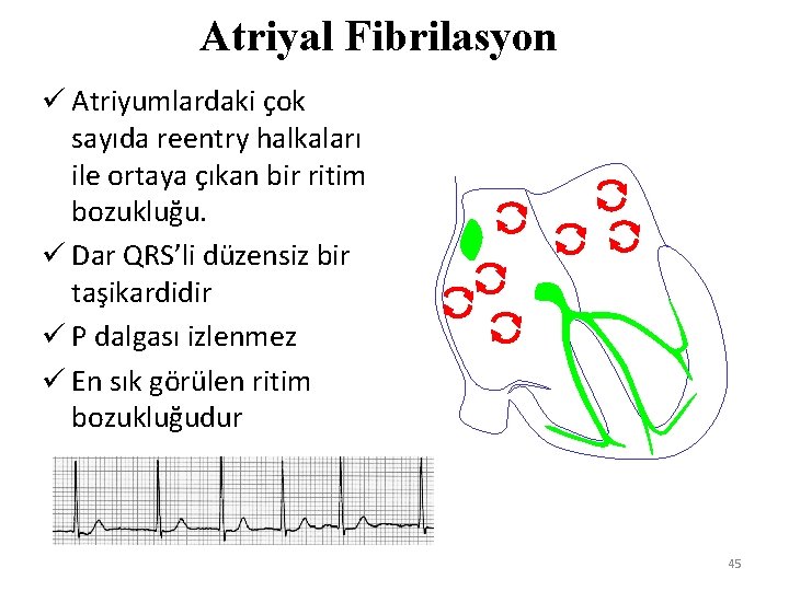 Atriyal Fibrilasyon ü Atriyumlardaki çok sayıda reentry halkaları ile ortaya çıkan bir ritim bozukluğu.