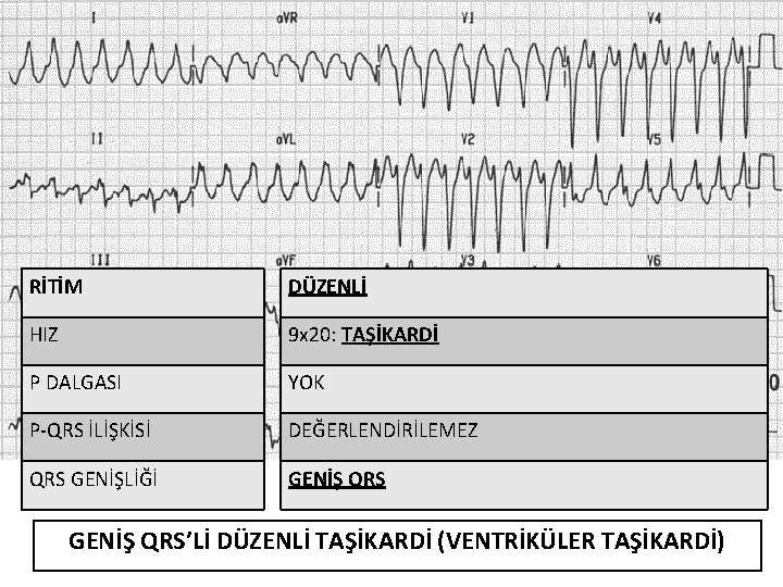 RİTİM DÜZENLİ HIZ 9 x 20: TAŞİKARDİ P DALGASI YOK P-QRS İLİŞKİSİ DEĞERLENDİRİLEMEZ QRS