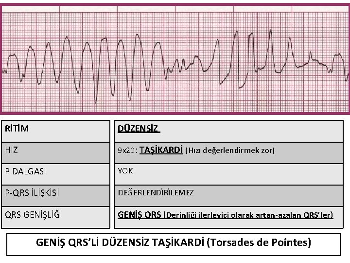 RİTİM DÜZENSİZ HIZ 9 x 20: TAŞİKARDİ (Hızı değerlendirmek zor) P DALGASI YOK P-QRS