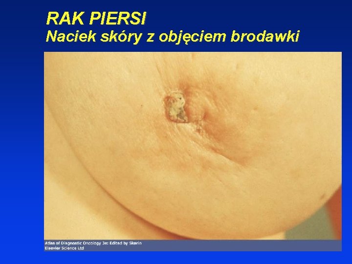 RAK PIERSI Naciek skóry z objęciem brodawki 