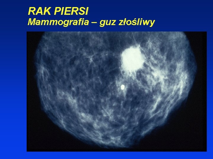 RAK PIERSI Mammografia – guz złośliwy 