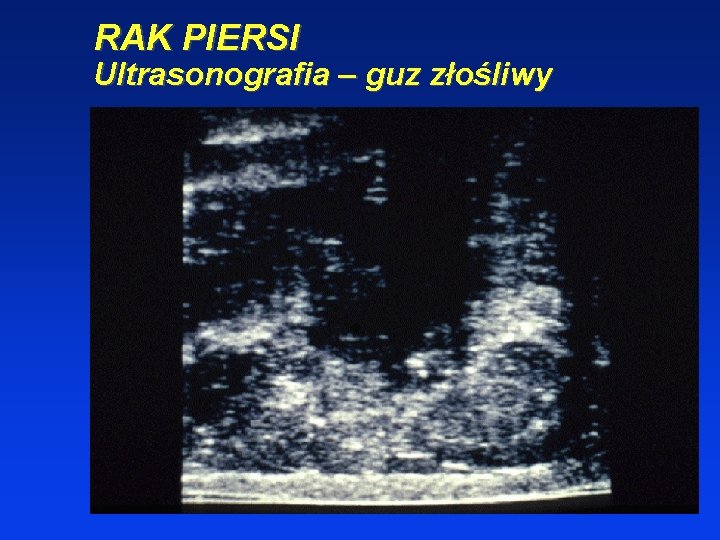 RAK PIERSI Ultrasonografia – guz złośliwy 