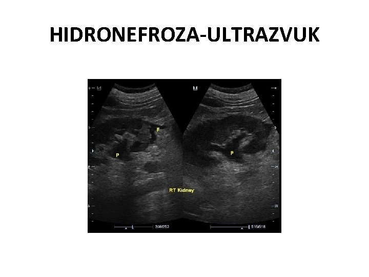 HIDRONEFROZA-ULTRAZVUK 