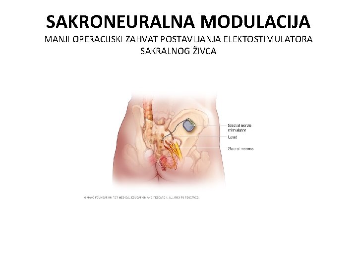 SAKRONEURALNA MODULACIJA MANJI OPERACIJSKI ZAHVAT POSTAVLJANJA ELEKTOSTIMULATORA SAKRALNOG ŽIVCA 