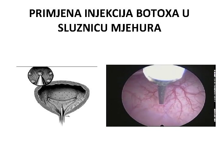 PRIMJENA INJEKCIJA BOTOXA U SLUZNICU MJEHURA 