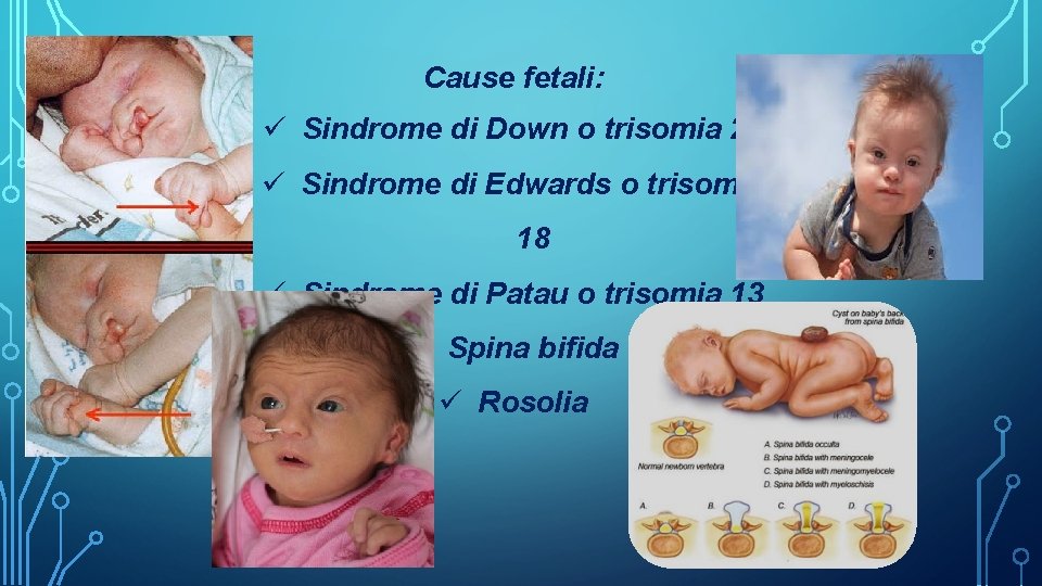 Cause fetali: ü Sindrome di Down o trisomia 21 ü Sindrome di Edwards o