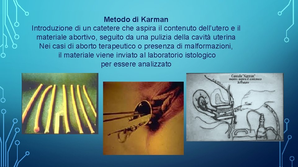 Metodo di Karman Introduzione di un catetere che aspira il contenuto dell’utero e il