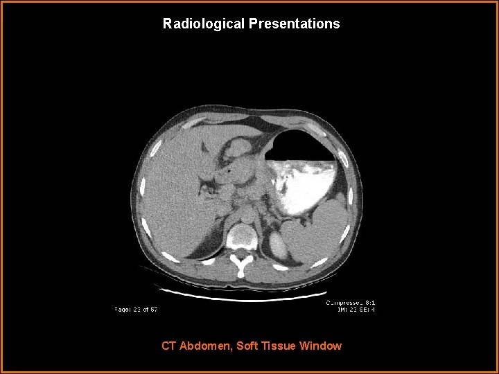 Radiological Presentations CT Abdomen, Soft Tissue Window 