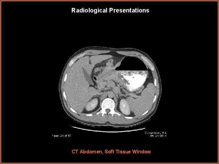 Radiological Presentations CT Abdomen, Soft Tissue Window 