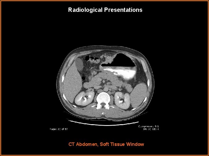 Radiological Presentations CT Abdomen, Soft Tissue Window 