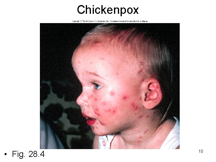 Chickenpox • Fig. 28. 4 10 