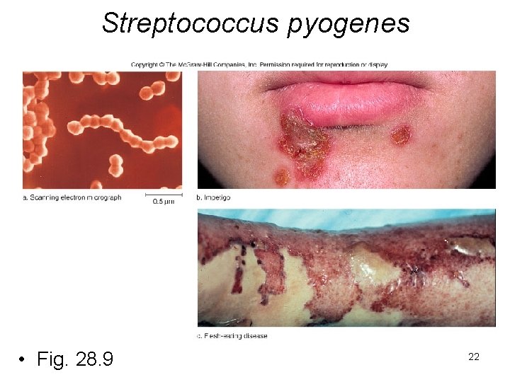 Streptococcus pyogenes • Fig. 28. 9 22 