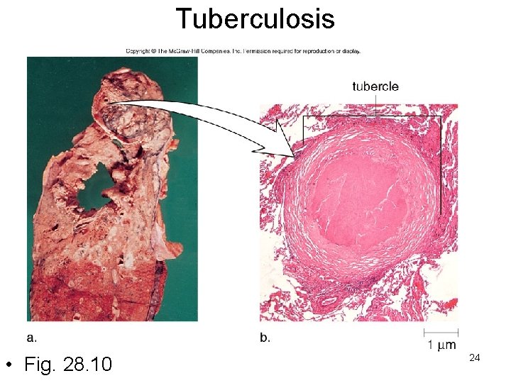 Tuberculosis • Fig. 28. 10 24 